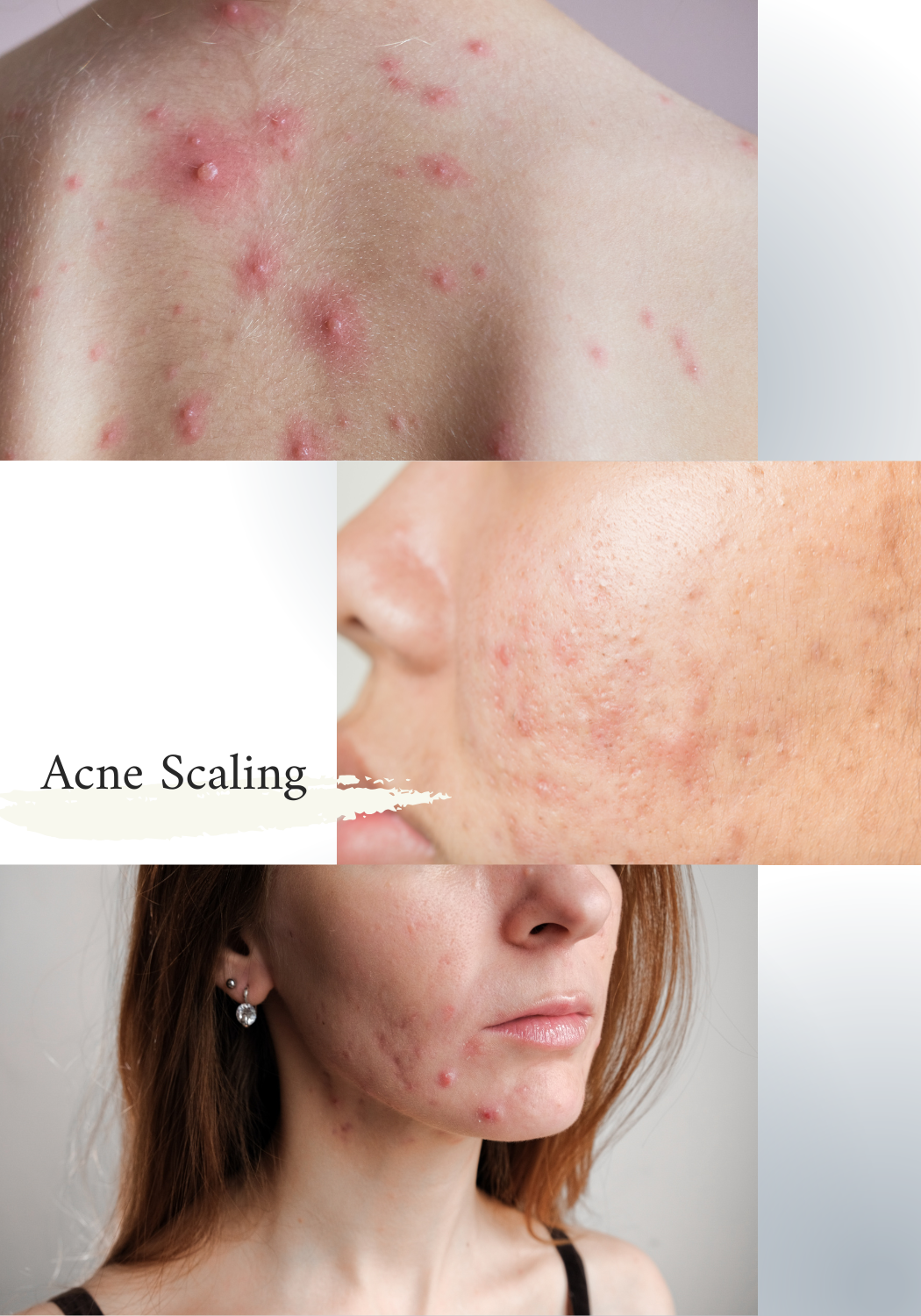 Healthkey DermaCare Pure Herbal Ointment for Acne