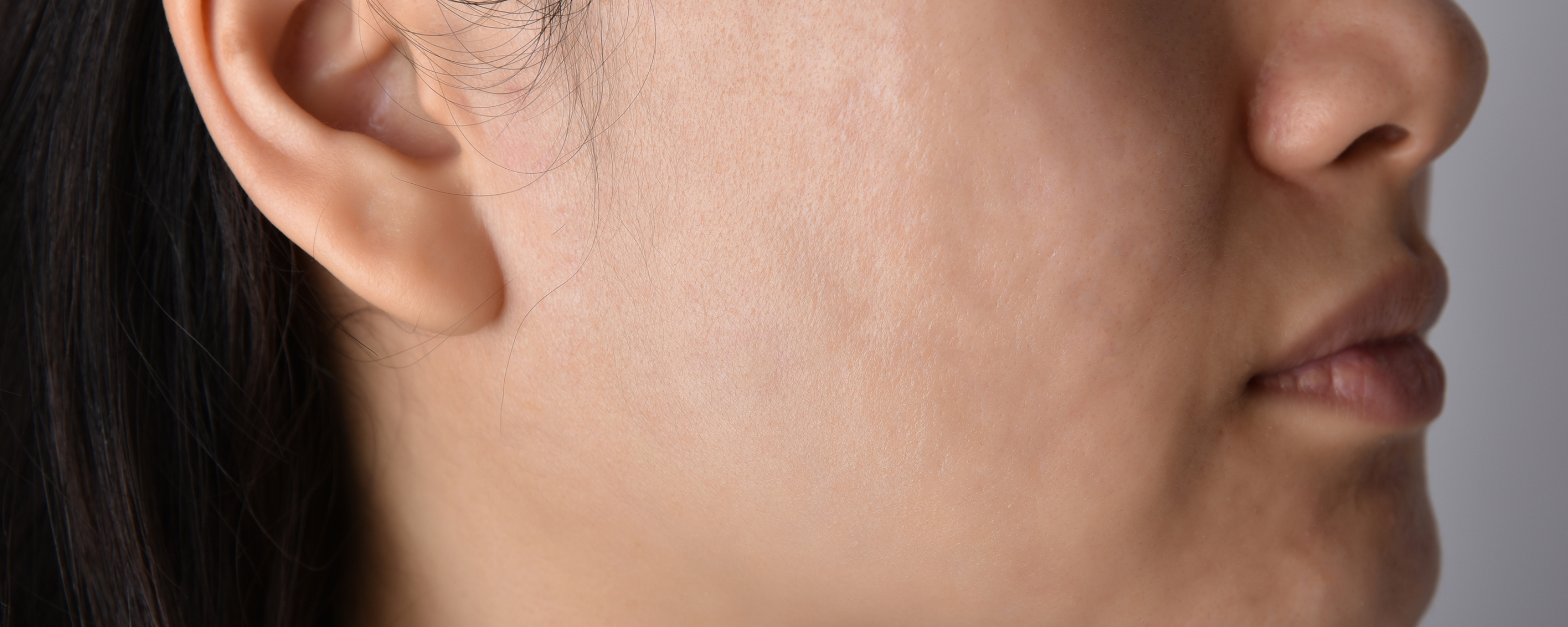 After Image showing after effect using DermaCare Acne Ointment
