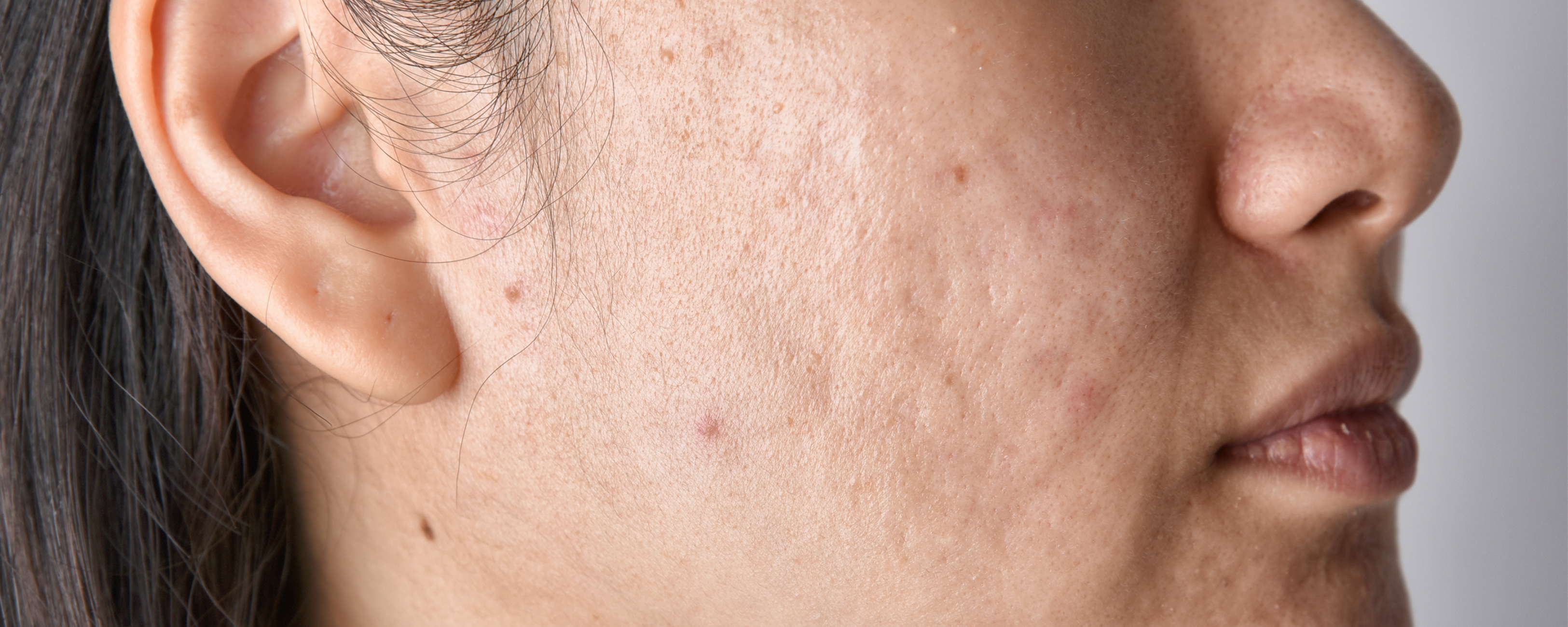 Before Image showing before effect using DermaCare Acne Ointment